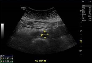 Abdominal Aortic Ultrasound Image