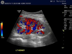 Left Kidney Flow Ultrasound Image