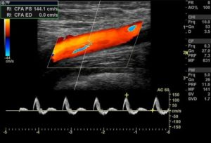 Lower Extremity Artery Ultrasound Image