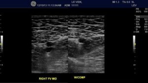 Lower Extremity Vein Ultrasound Image